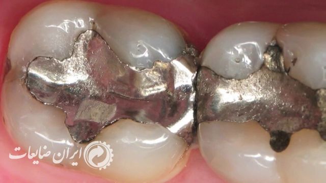 ضایعات وپسماند آمالگام دندان پزشکی